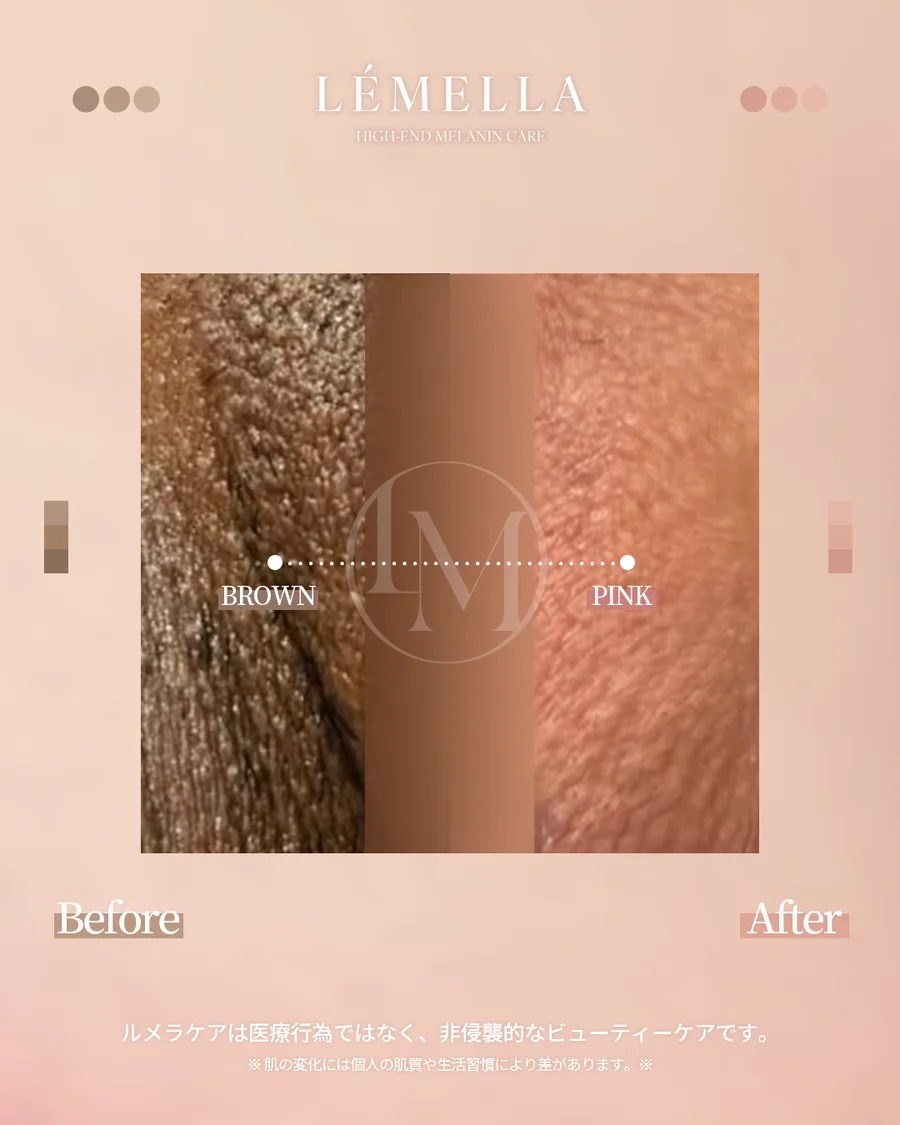 メラニンケア(ルメラ) Before After 施術例 83