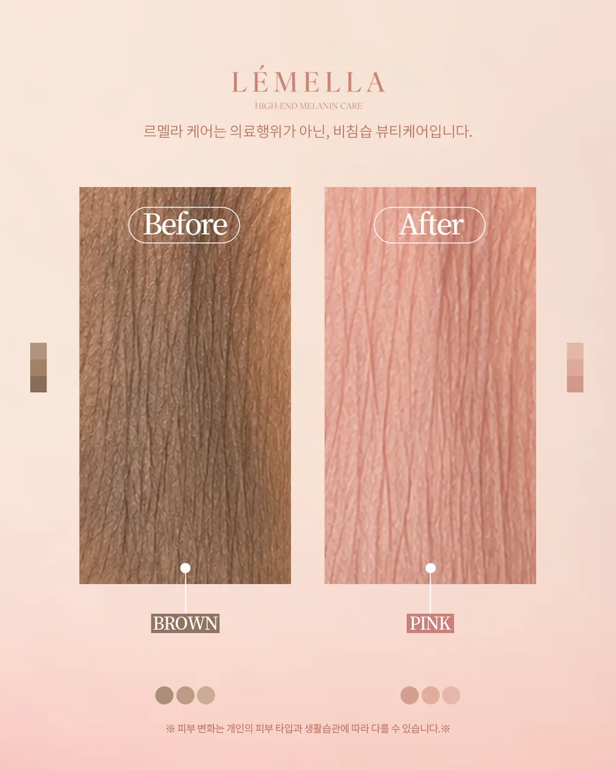 メラニンケア(ルメラ) Before After 施術例 1