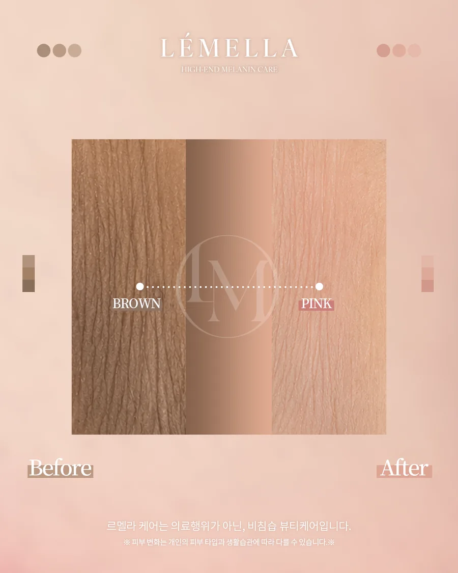 メラニンケア(ルメラ) Before After 施術例 4