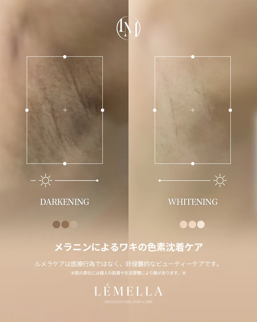 メラニンケア(ルメラ) Before After 施術例 11