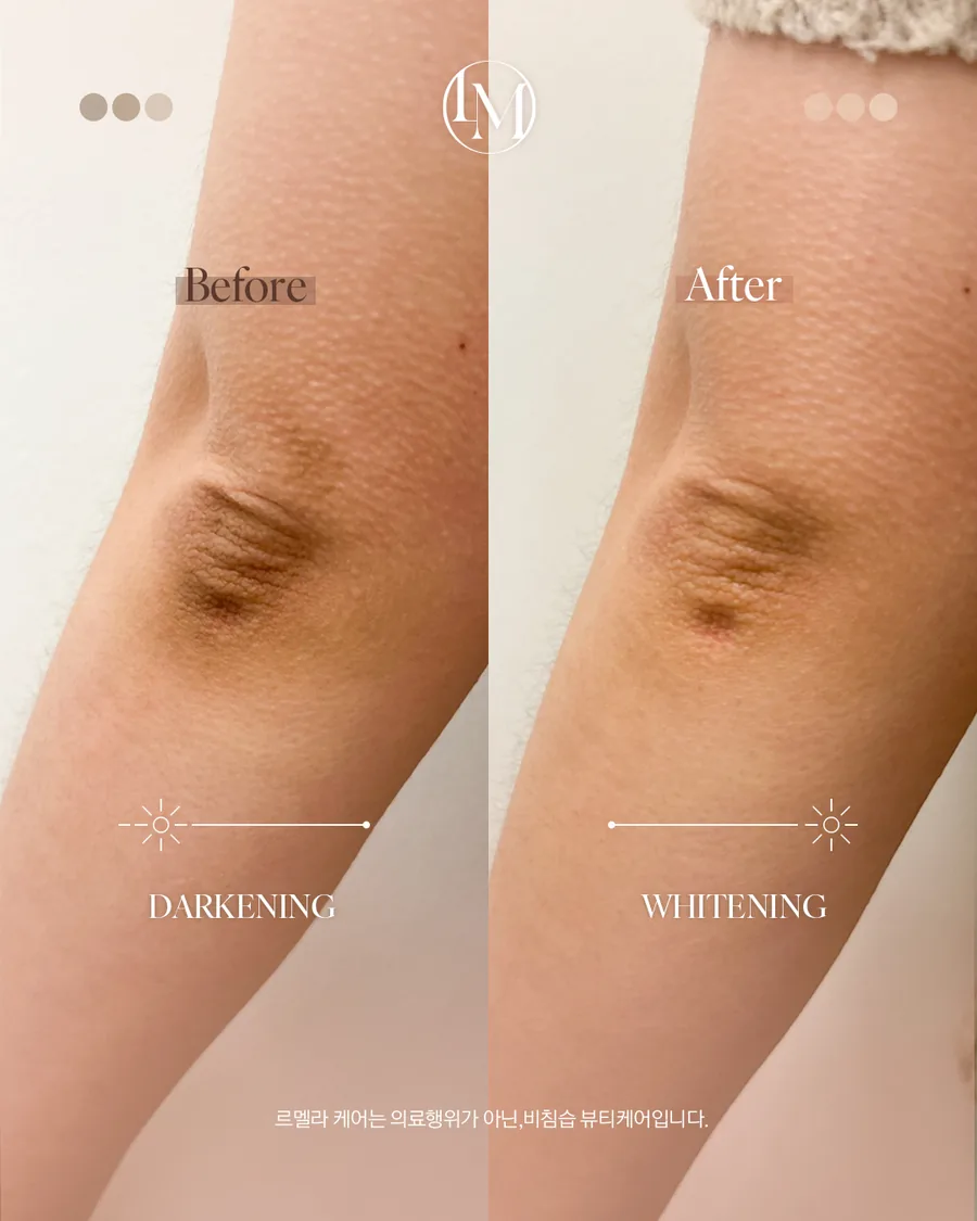 メラニンケア(ルメラ) Before After 施術例 44