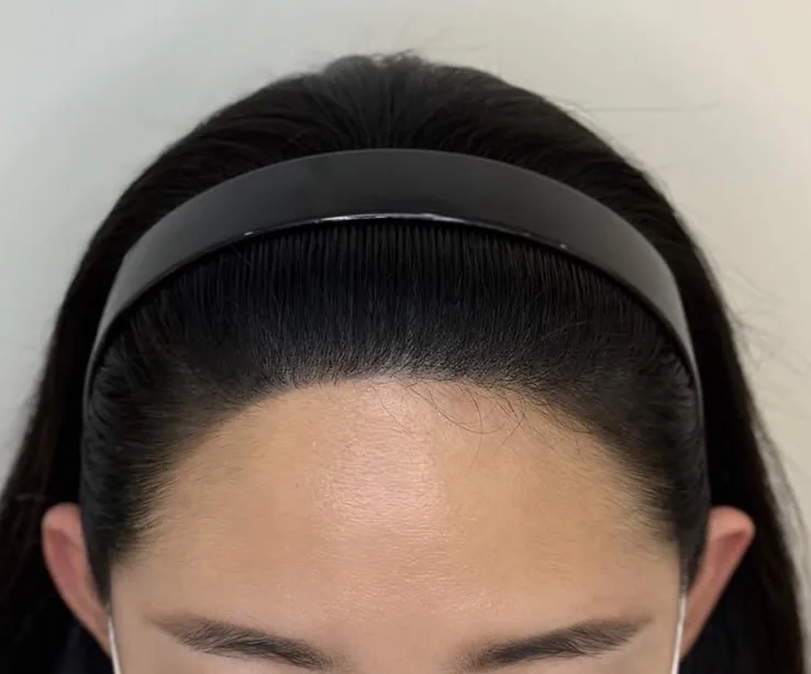 ヘアラインSMP Before After 施術例 2