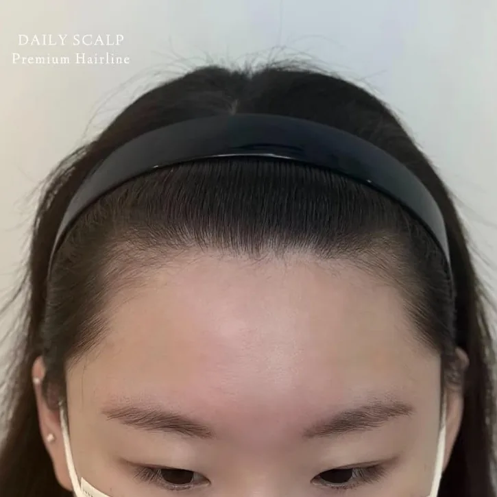 ヘアラインSMP Before After 施術例 3