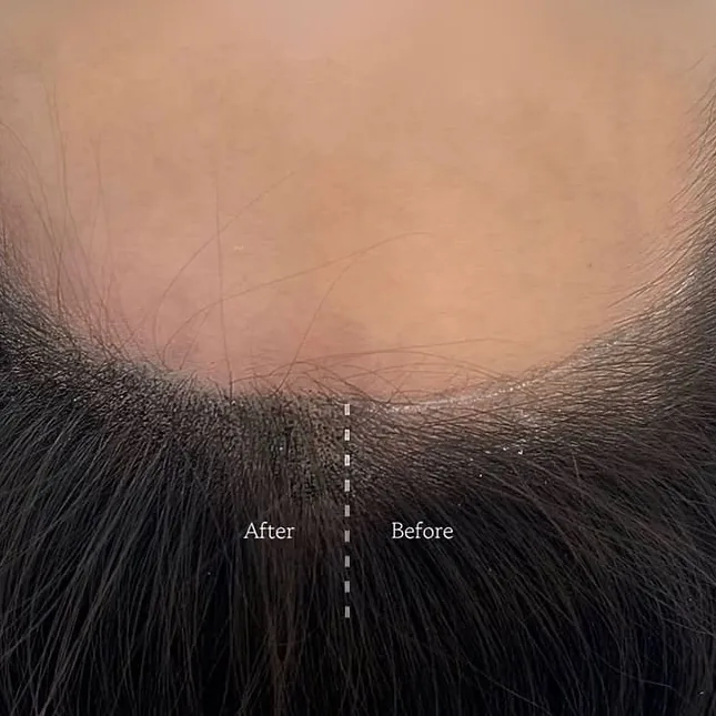 ヘアラインSMP Before After 施術例 5
