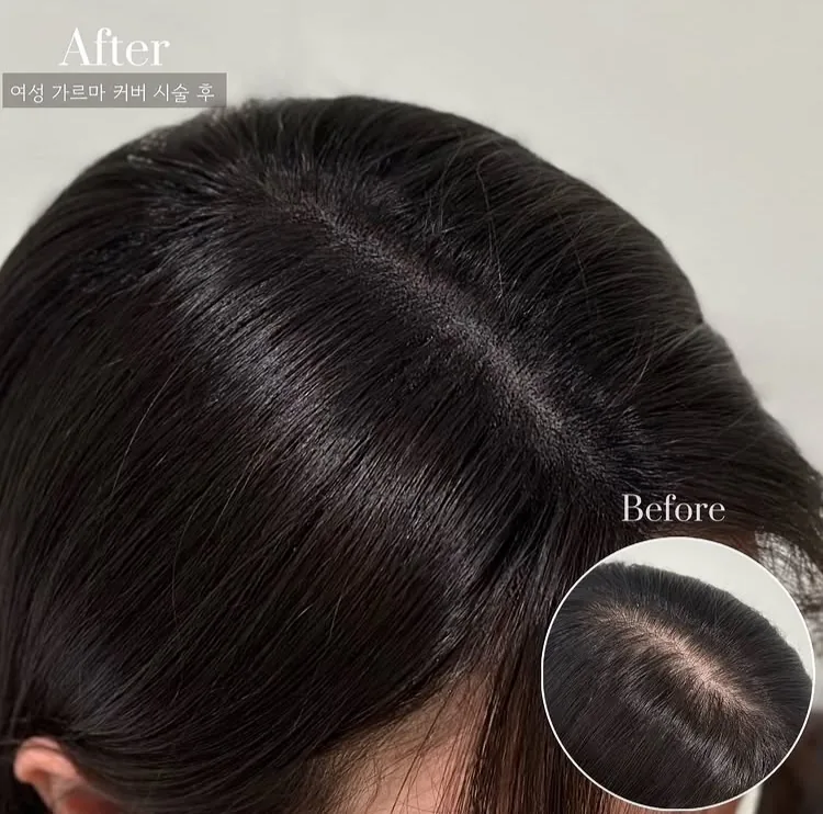 ヘアラインSMP Before After 施術例 12