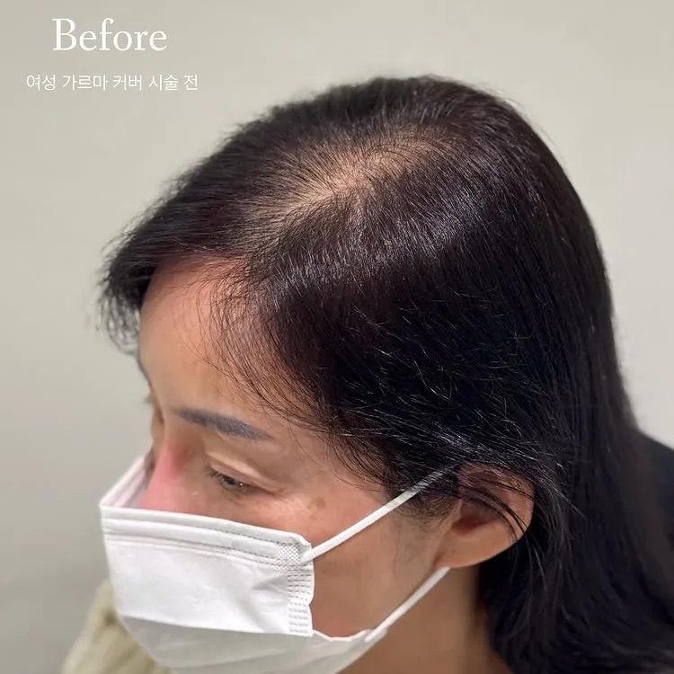 ヘアラインSMP Before After 施術例 19