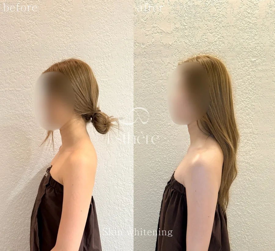 全身ホワイトニングケア Before After 施術例 2