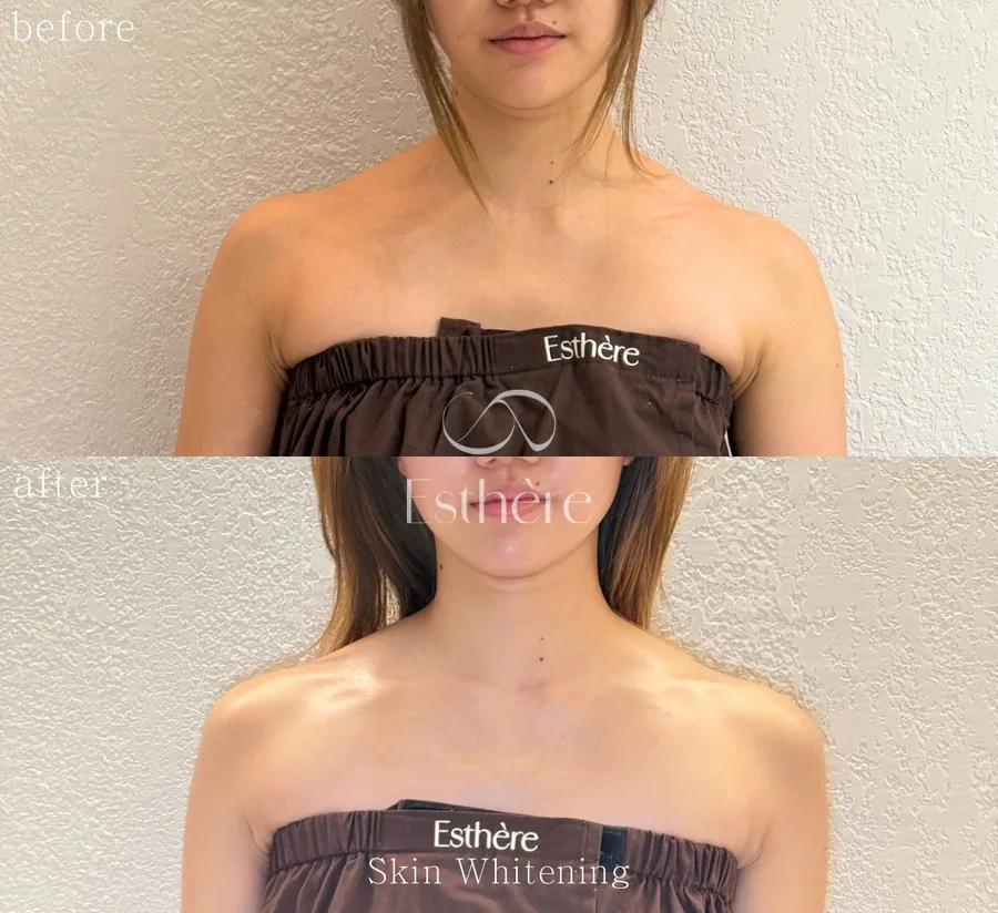 全身ホワイトニングケア Before After 施術例 6