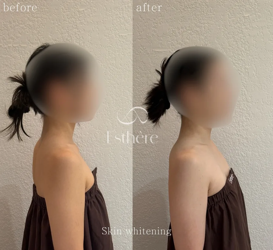 全身ホワイトニングケア Before After 施術例 12