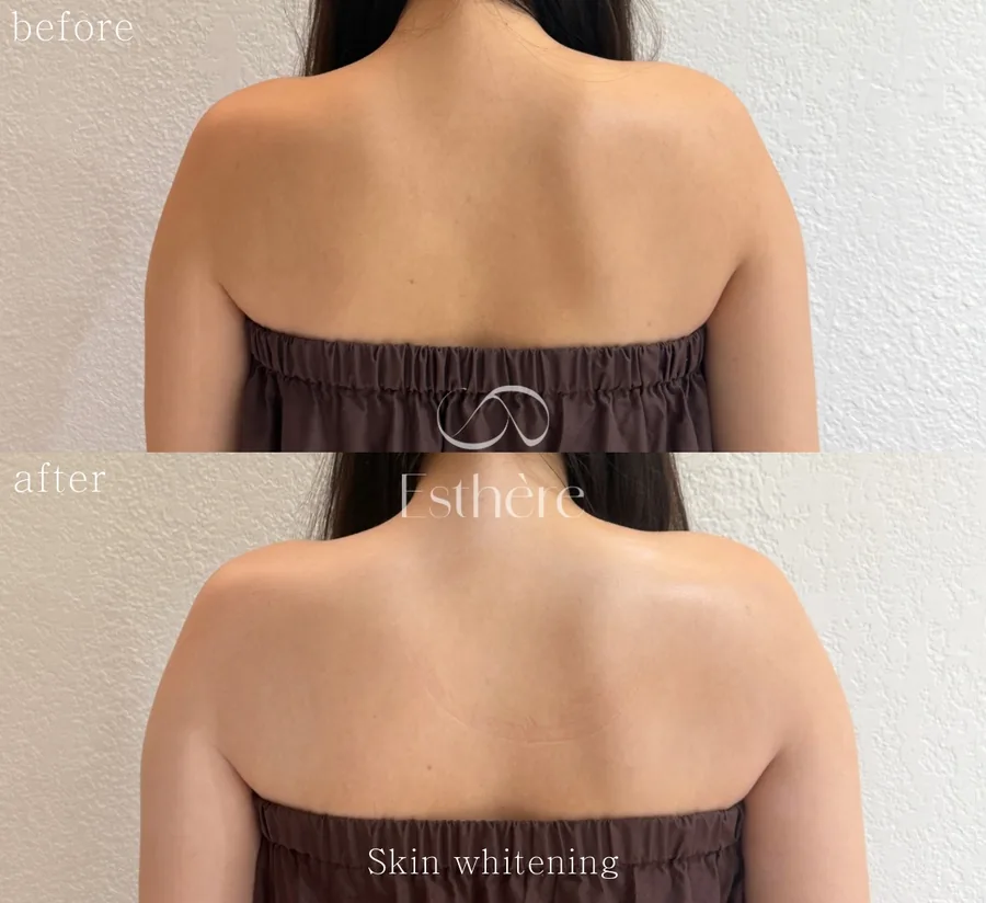 全身ホワイトニングケア Before After 施術例 20