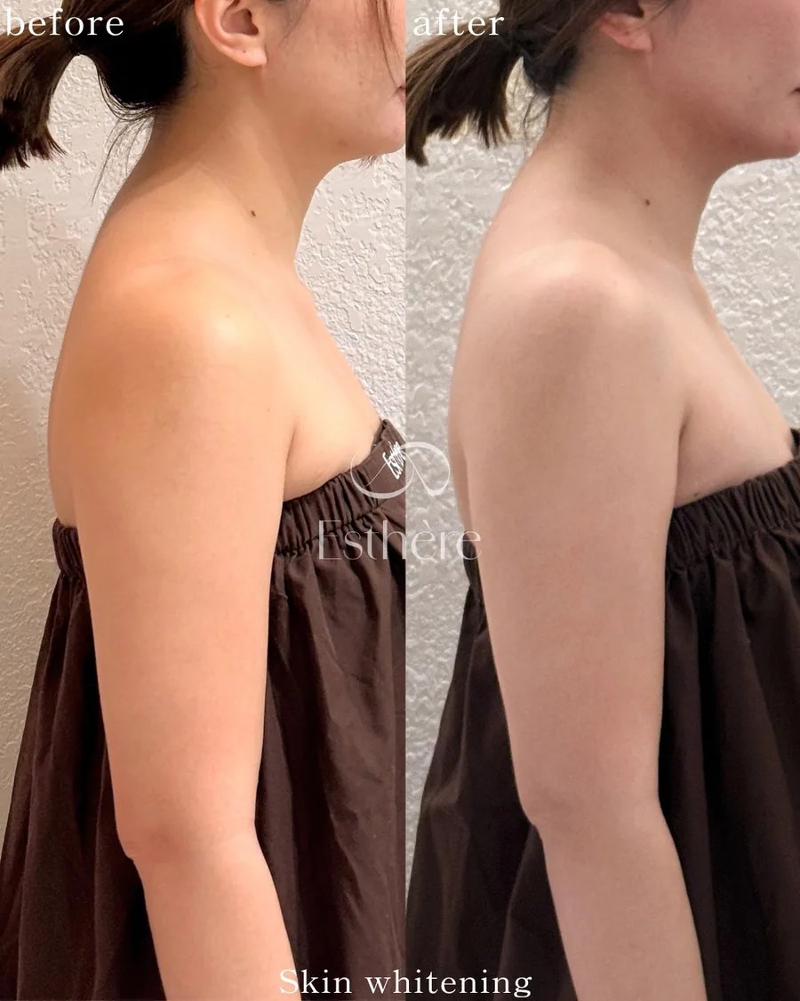 全身ホワイトニングケア Before After 施術例 29