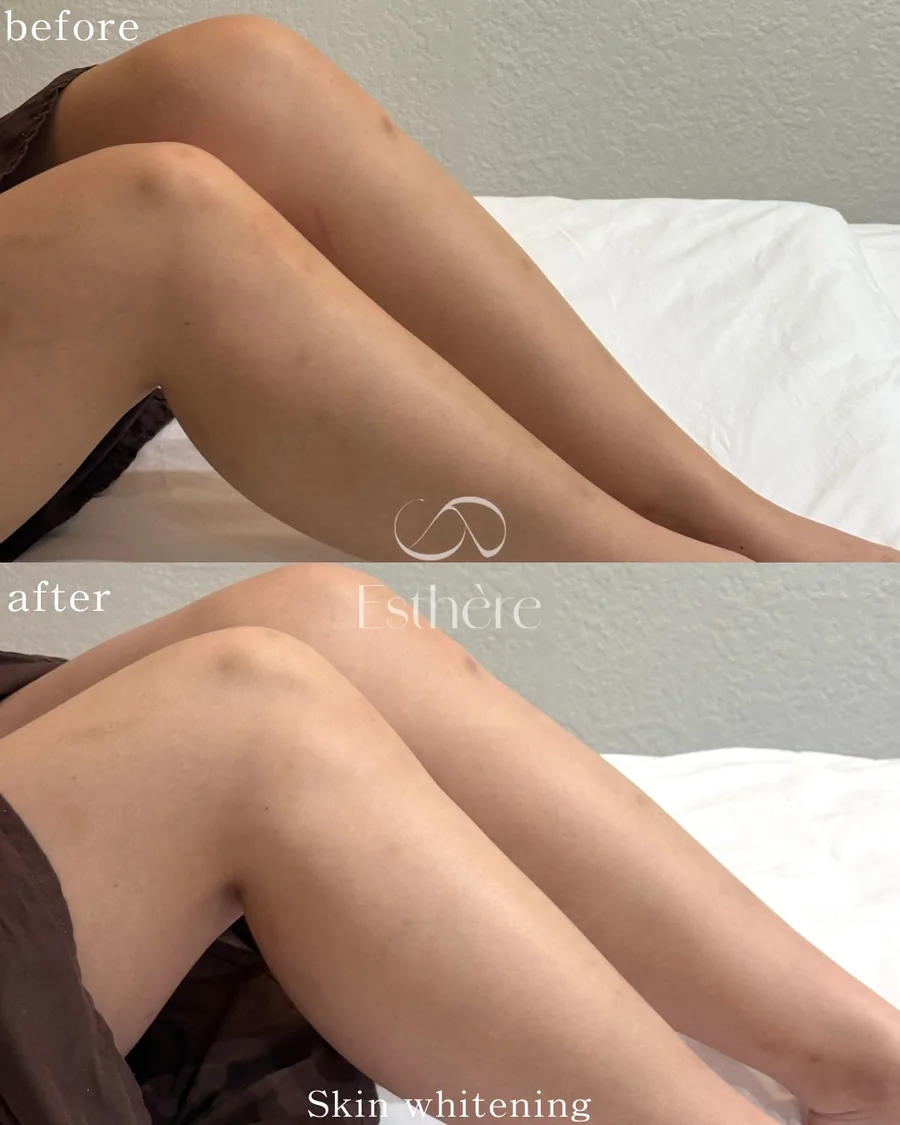 全身ホワイトニングケア Before After 施術例 31